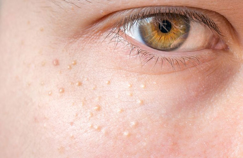 Cách chăm sóc da hiệu quả để trị mụn cơm quanh mắt là gì?
