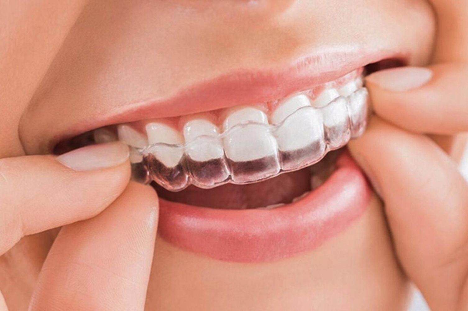 Niềng răng để điều chỉnh mặt lệch, giúp khuôn mặt cân đối