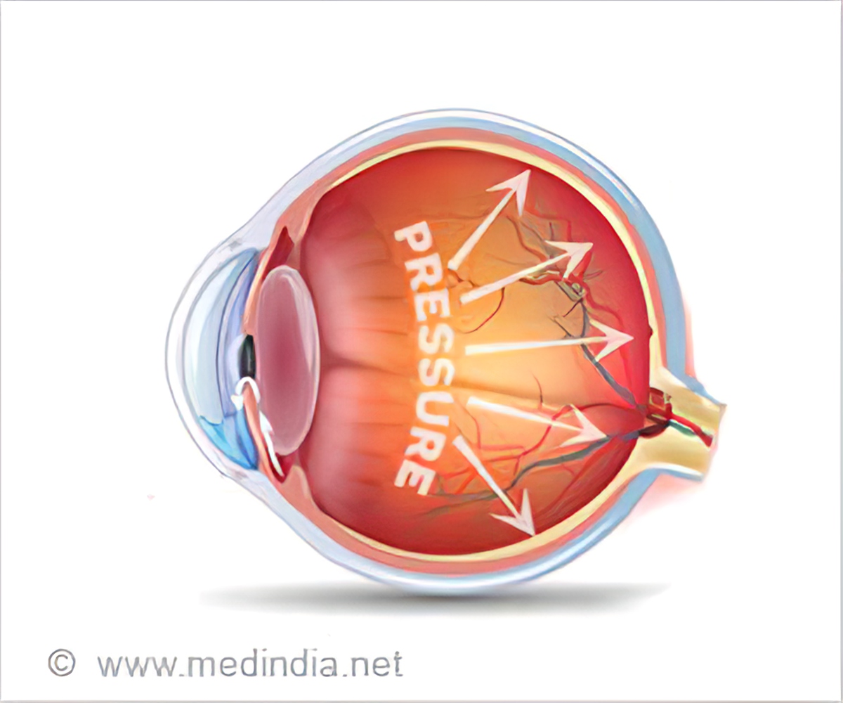 Tác hại của việc mổ mắt cận thị: Tăng nhãn áp