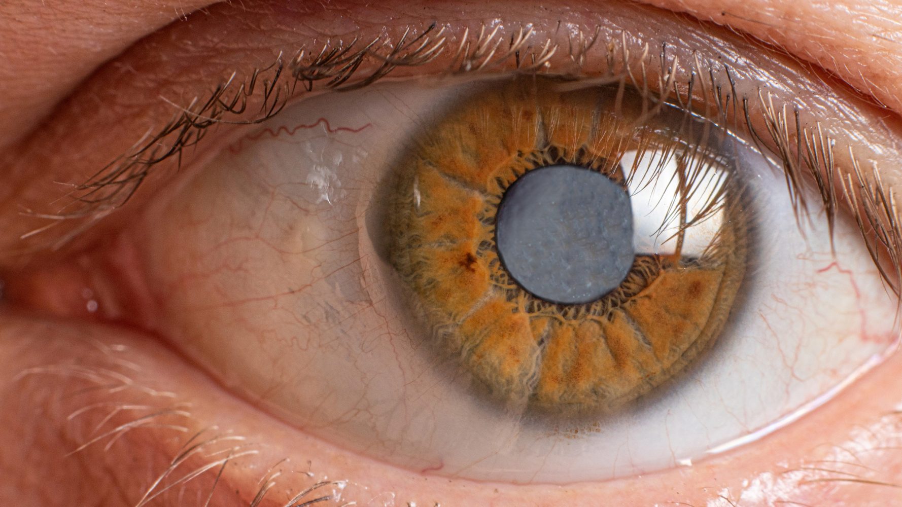Tác hại của mổ cận thị ở mắt: Đục thủy tinh thể